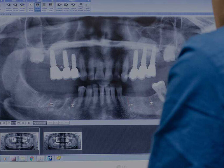 impianti dentali dentista torino dott andrea bianco