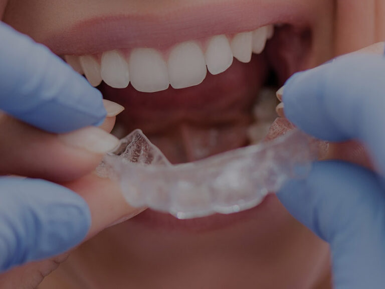 ortodonzia invisibile dentista torino andrea bianco