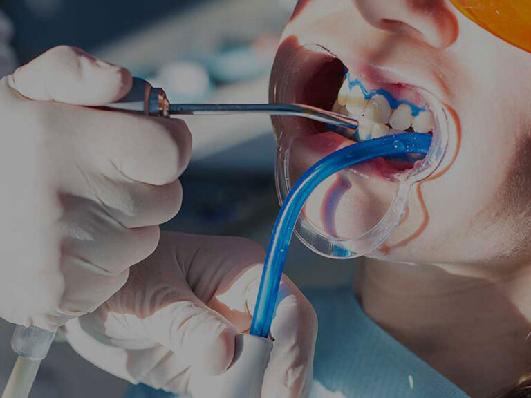 sbiancamento dentale dentista torino andrea bianco