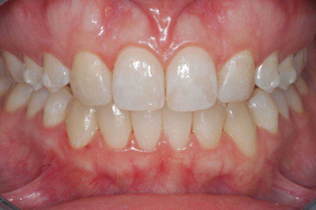 invisalign 1 post