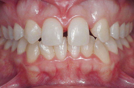 invisalign 1 pre
