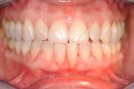 invisalign 2 pre
