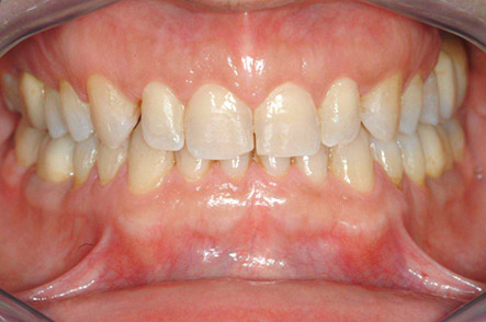 invisalign 3 post