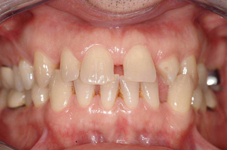 invisalign 3 pre