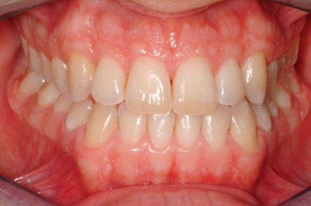 invisalign 4 post
