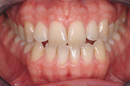 invisalign 4 pre