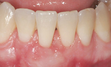 recessione gengivale 1 post