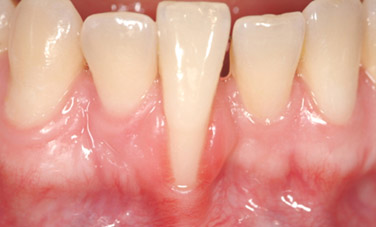 recessione gengivale 1 pre