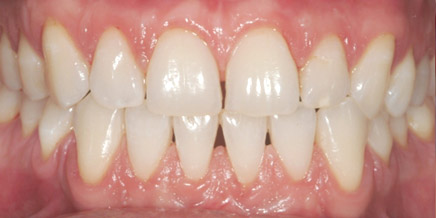 recessione gengivale 2 post