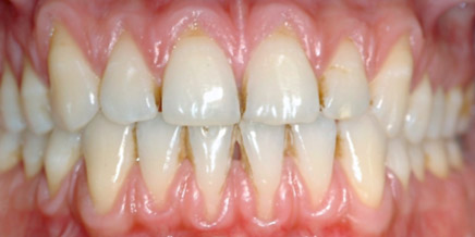 recessione gengivale 2 pre