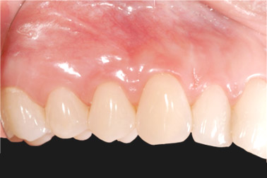 recessione gengivale 3 post