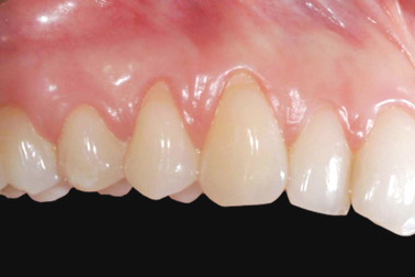 recessione gengivale 3 pre