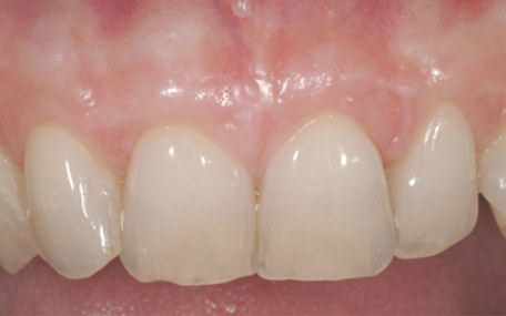 recessione gengivale 4 post