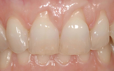 recessione gengivale 4 pre